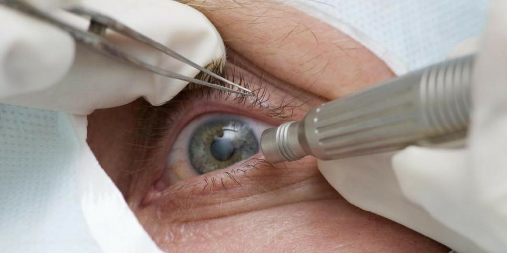 Cirurgia que altera cor do olho tem uso restrito para pessoas cegas